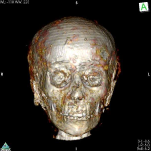 6655558 اكتشاف أثري ببدروم المتحف المصري.. 100 عام على اكتشاف «مومياء الصبي الذهبي».. والآشعة المقطعية تفجر مفاجأة (صور)